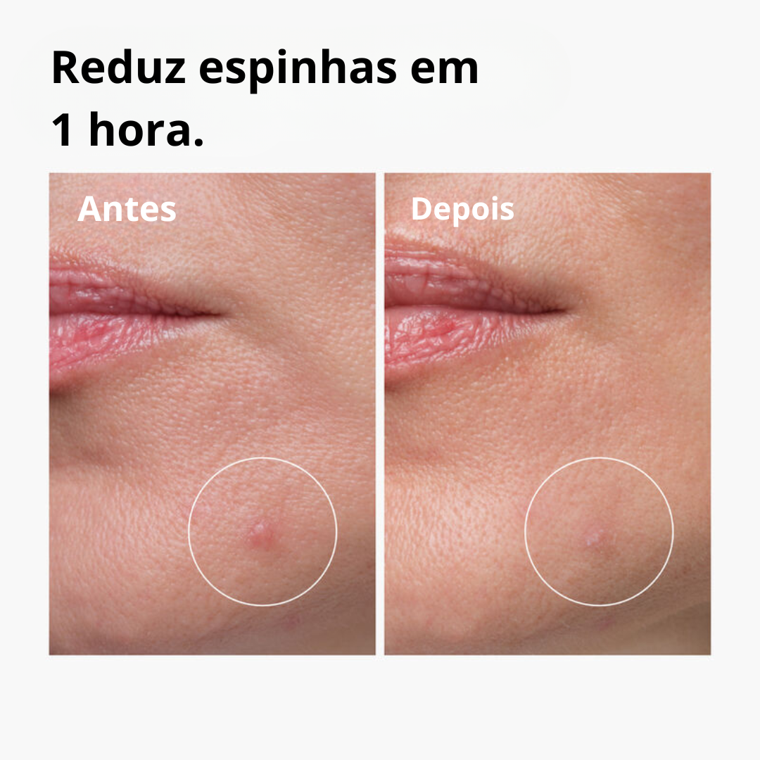 The Ordinary Sulfur 10% Powder-to-Cream Concentrate Tratamento Antiacne com Enxofre