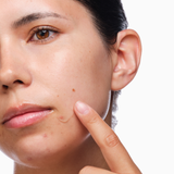 The Ordinary The Acne Set Kit Completo para Pele com Acne