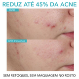 Effaclar Sérum Antiacne com Ácido Salicílico 1,5%